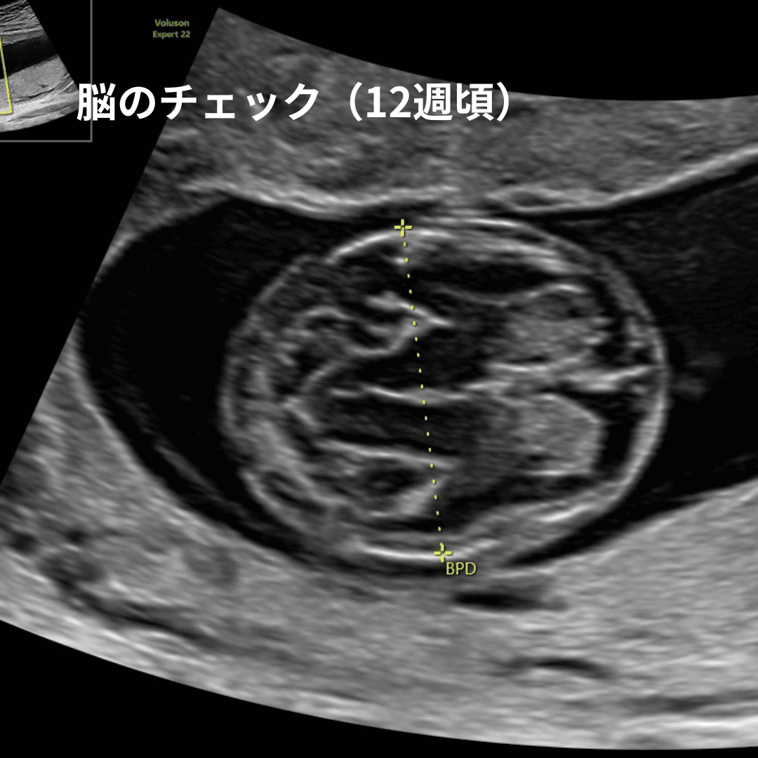 妊娠12週頃の赤ちゃんの脳の超音波画像