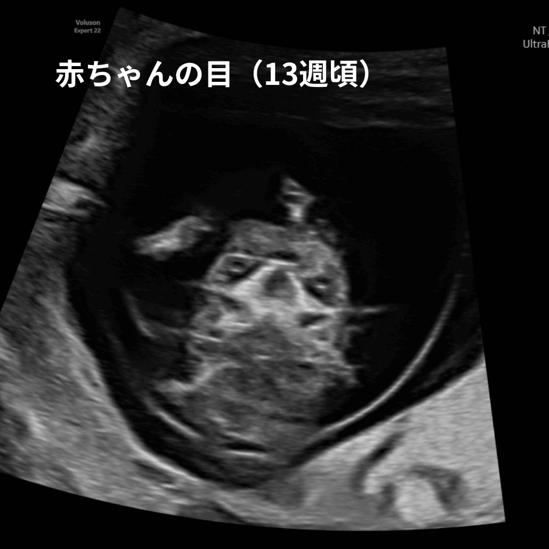 妊娠13週頃の赤ちゃんの目の超音波画像