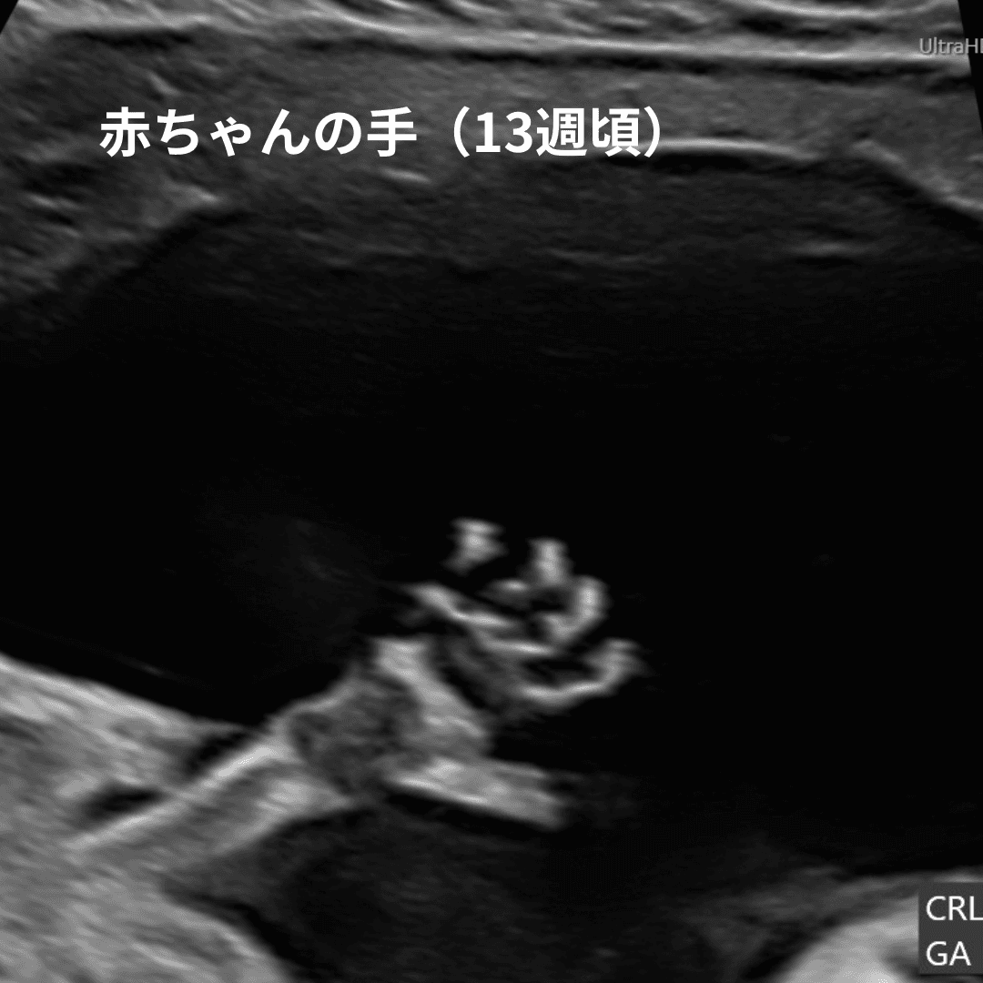 妊娠13週頃の赤ちゃんの手の超音波画像
