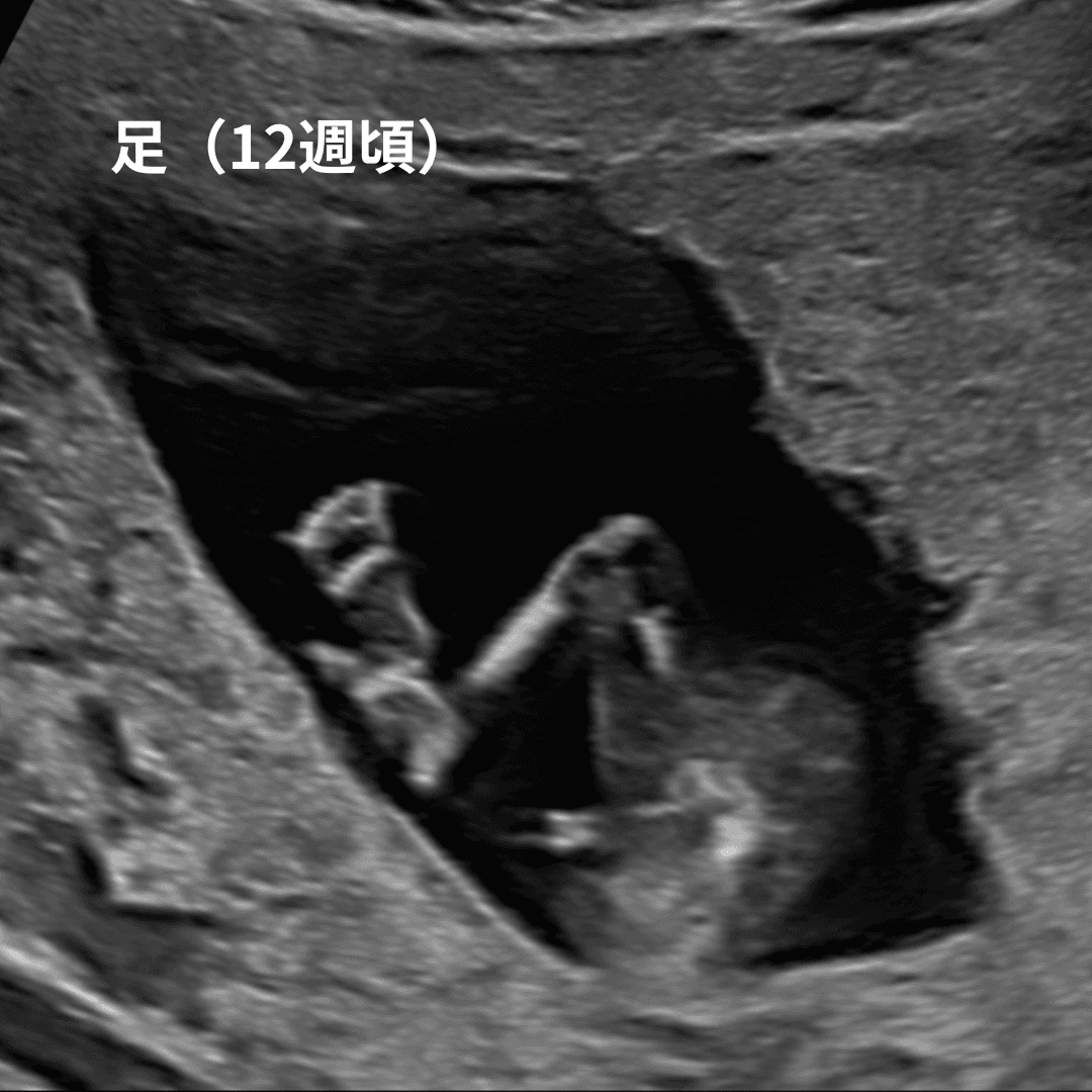 妊娠12週頃の赤ちゃんの足の超音波画像