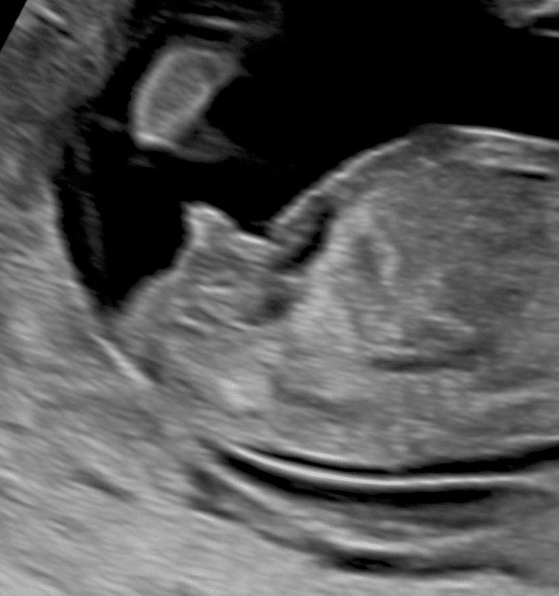 妊娠初期の男の子の所見を示す超音波画像