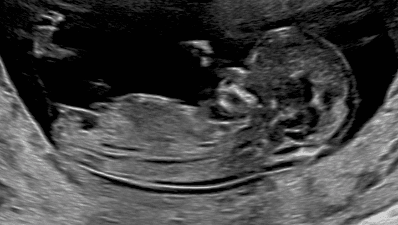 性別の確認に適した、頭殿長(CRL)を測る正中断面の超音波画像