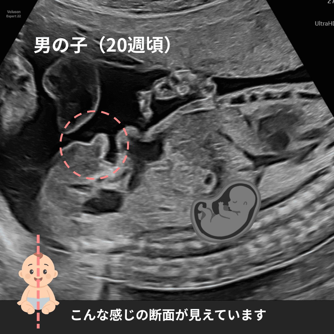 妊娠20週頃の男の子の外性器の超音波画像