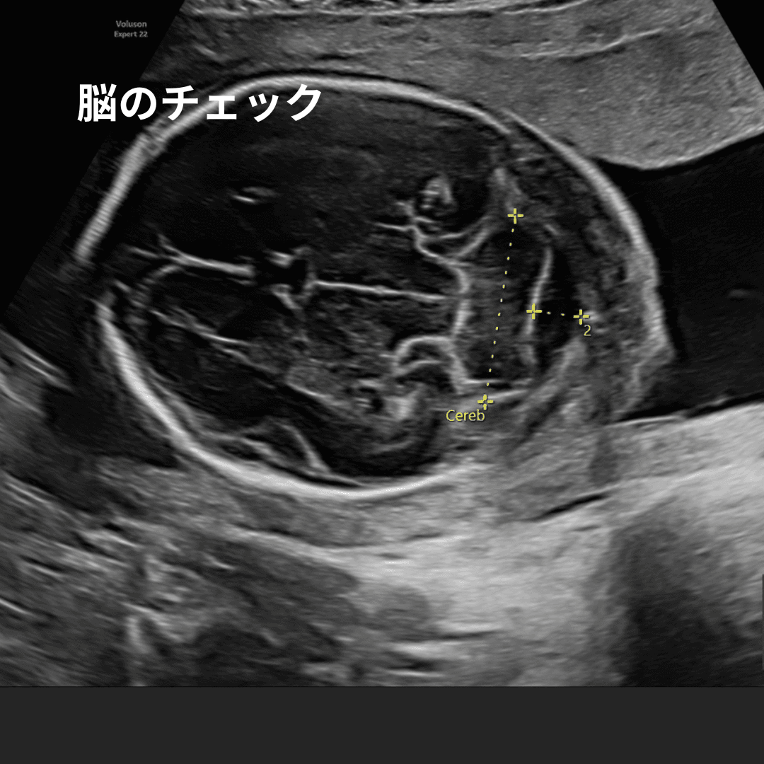 妊娠中期の赤ちゃんの脳の超音波画像