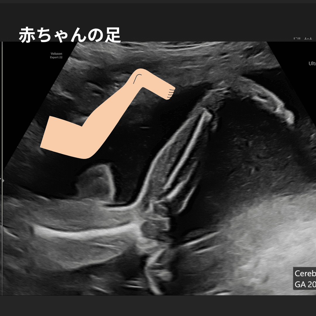 妊娠中期の赤ちゃんの足の超音波画像
