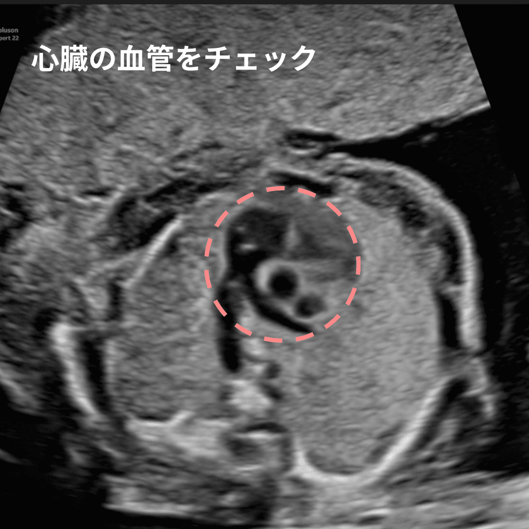 心臓の血管の断面を確認している超音波画像