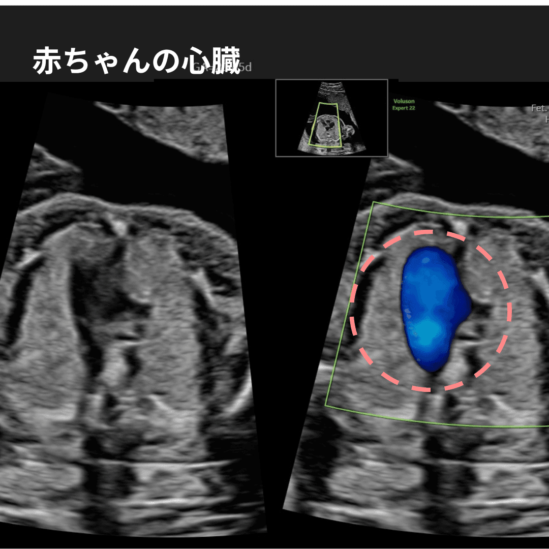 妊娠中期の赤ちゃんの心臓の超音波画像