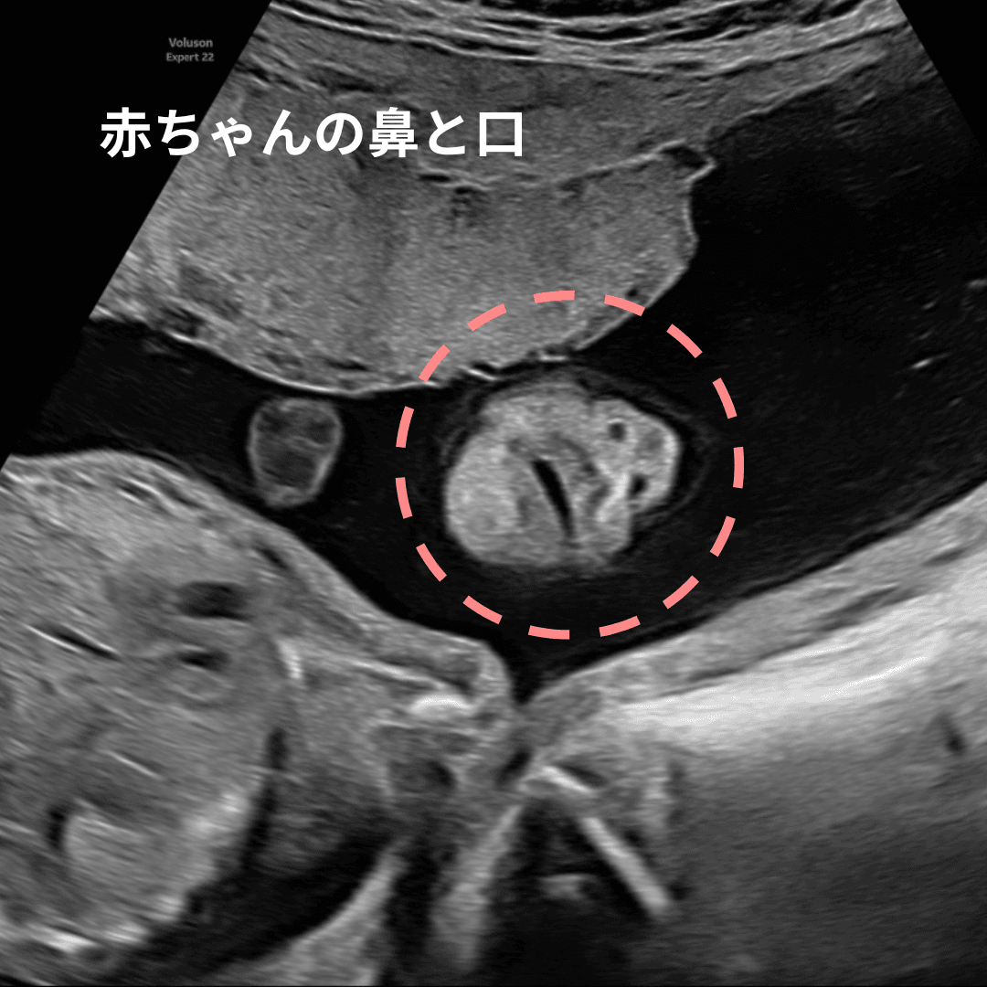 妊娠中期の赤ちゃんの鼻と口の超音波画像