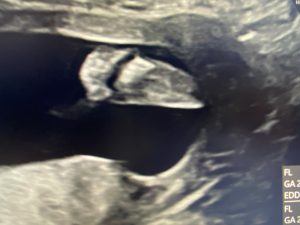 胎児超音波検査（イメージ）